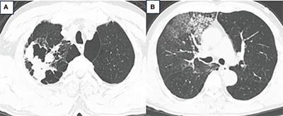 A case of surgically treated non-metastatic SMARCA4-deficient undifferentiated thoracic tumor: a case report and literature review